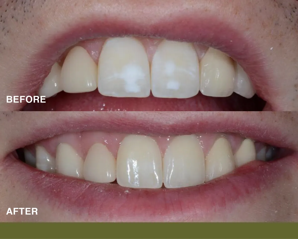 Drill-free, needle-free, pain-free ICON treatment to rid of white spots