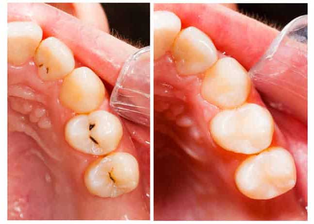 Cavities on two front teeth - fillings were placed to make it look like nothing ever happened