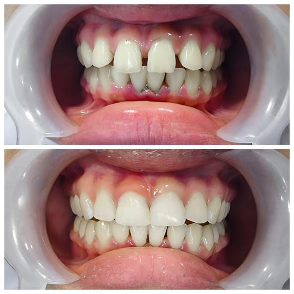 This patient was not a candiates for Invisalign to close the spaces - we placed bondings to close them in one visit