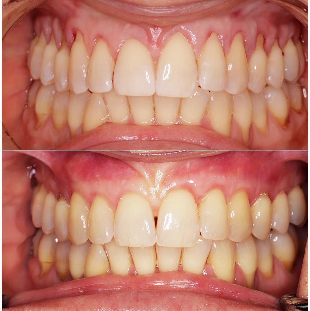 Gum graft to cover exposed root structure