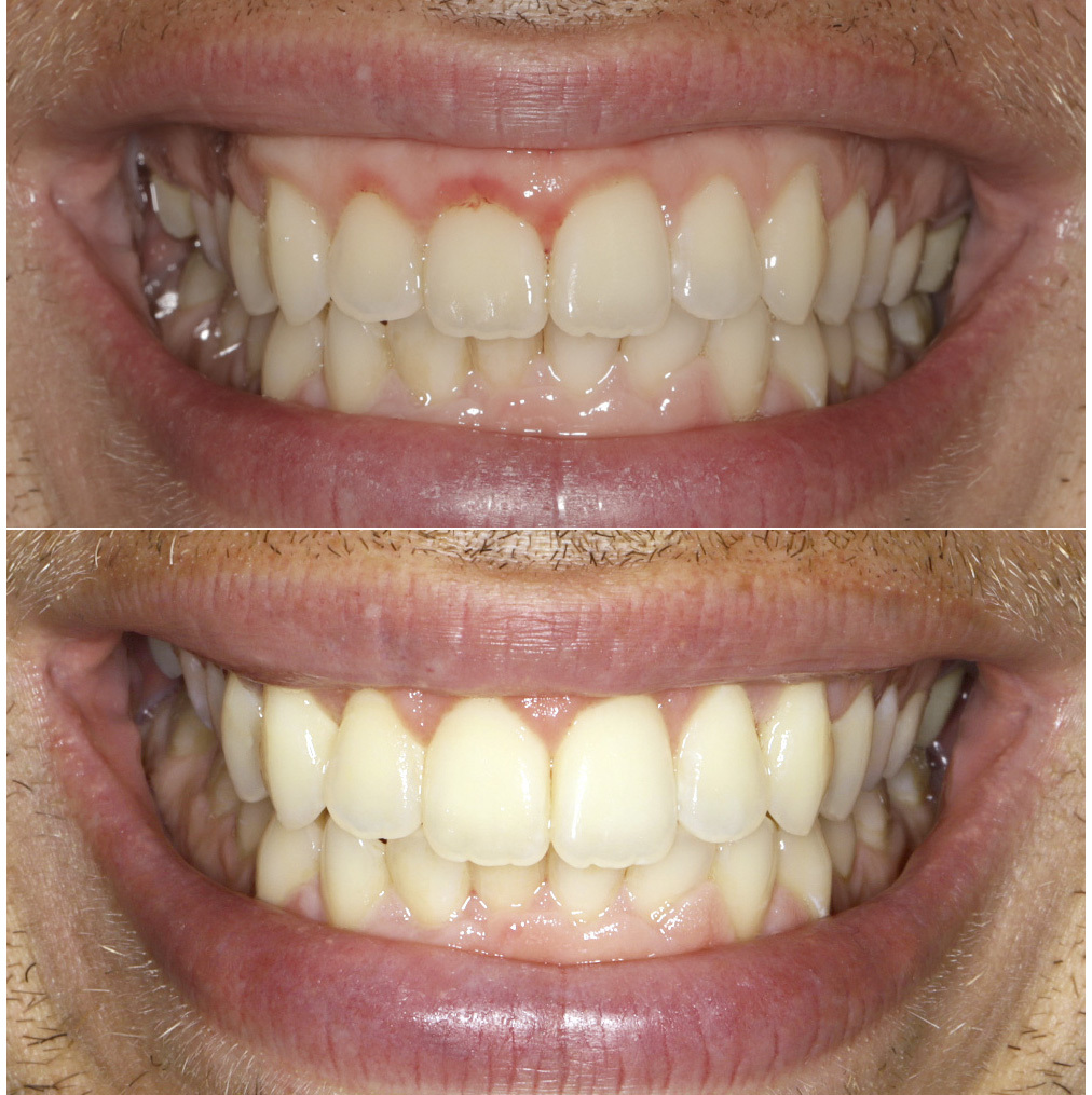 Gum graft to cover exposed root structure