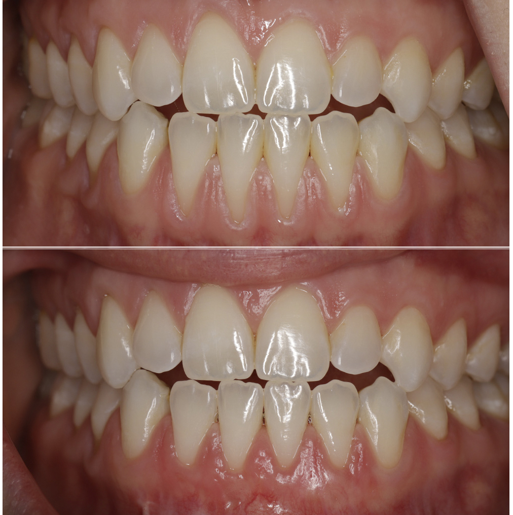 Gum graft to cover exposed root structure