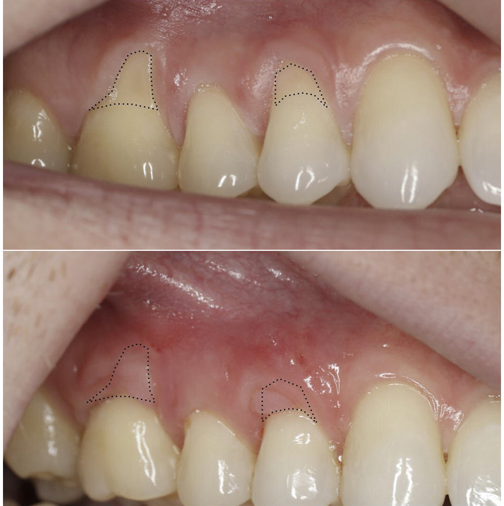 Gum graft to cover exposed root structure