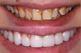 Congenitally discolored enamel and cavities were treated with handcrafted porcelain veneers for this gorgeous patient.