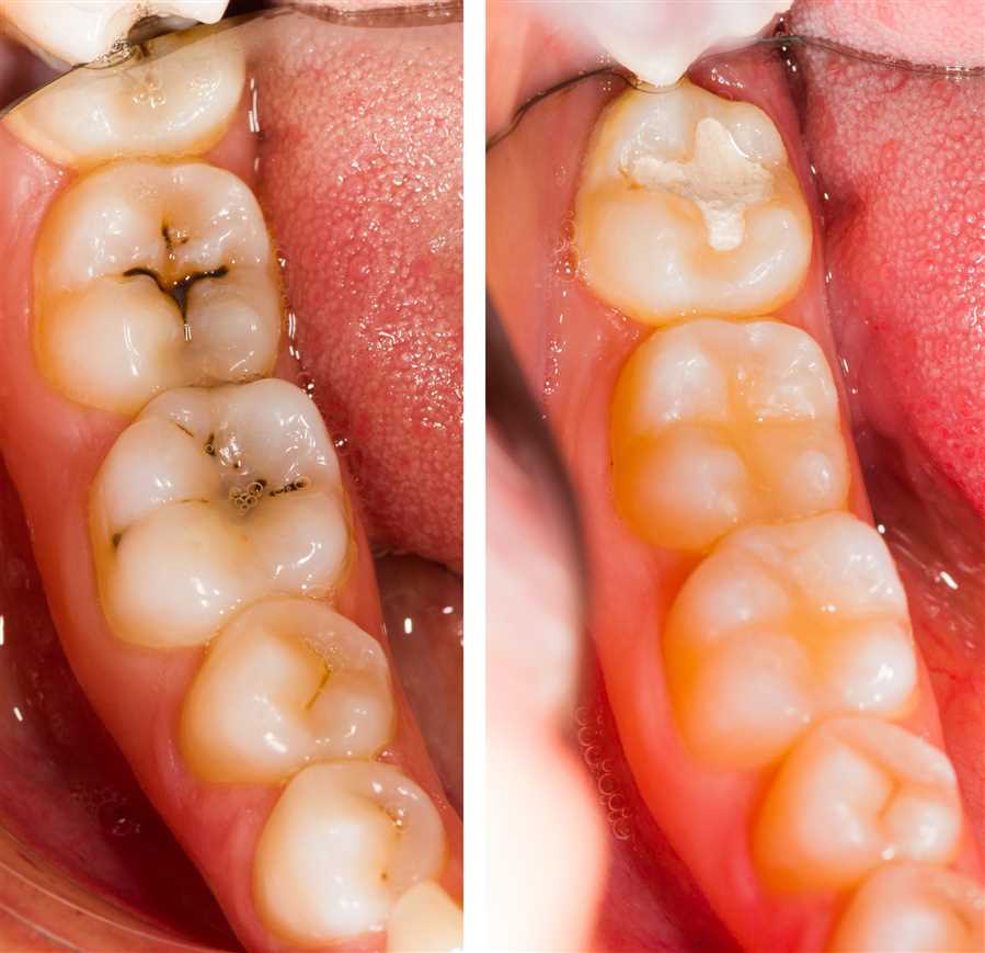 Cavities on two front teeth - fillings were placed to make it look like nothing ever happened