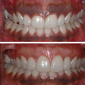 This patient always felt like it looked like food was stuck in her teeth - laser depigmentation was performed in one painless visit to change the way she felt about her smile