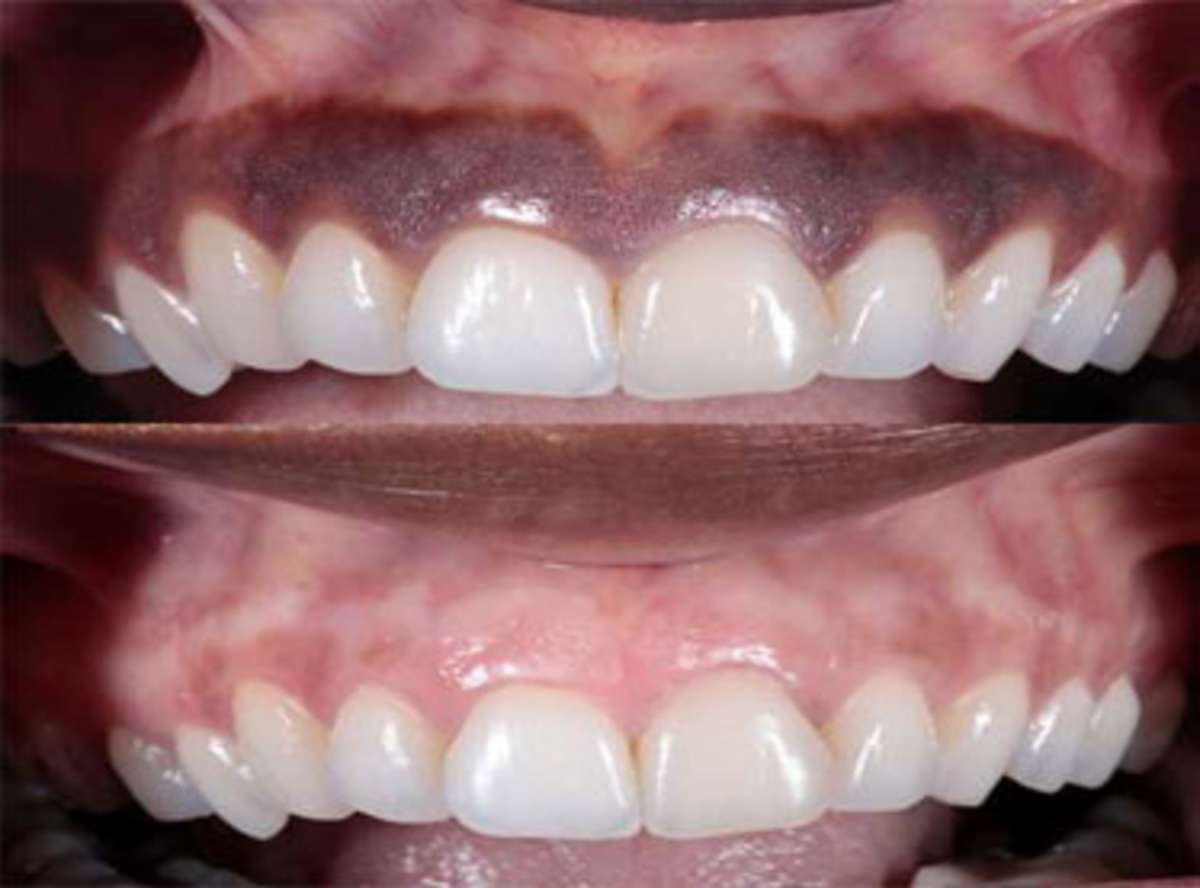 This patient always felt like it looked like food was stuck in her teeth - laser depigmentation was performed in one painless visit to change the way she felt about her smile