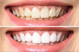 KoR whitening- Easy, long-lasting, and highly effective