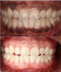 This patient always felt like it looked like food was stuck in her teeth - laser depigmentation was performed in one painless visit to change the way she felt about her smile