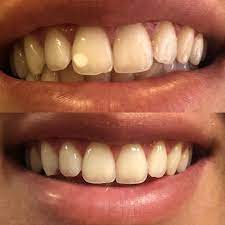 Drill-free, needle-free, pain-free ICON treatment to rid of white spots