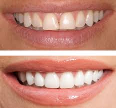 This patient was not a candiates for Invisalign to close the spaces - we placed bondings to close them in one visit