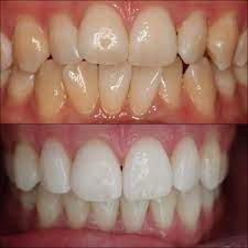 KoR whitening- Easy, long-lasting, and highly effective