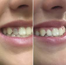After 10+ years of being told nothing could be done, the patient couldn't believe the stunning results after this one-visit procedure
