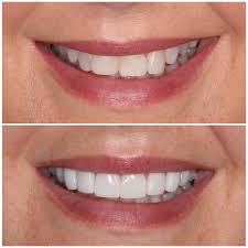 This patient was not a candiates for Invisalign to close the spaces - we placed bondings to close them in one visit