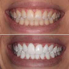 KoR whitening- Easy, long-lasting, and highly effective
