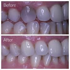 After 10+ years of being told nothing could be done, the patient couldn't believe the stunning results after this one-visit procedure