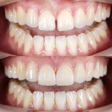 This patient was not a candiates for Invisalign to close the spaces - we placed bondings to close them in one visit