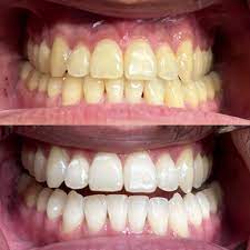KoR whitening- Easy, long-lasting, and highly effective