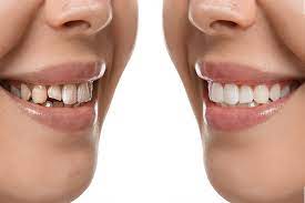 Dr. Jyotika Kaushik Goodman is Top 1% Invisalign provider in the country!