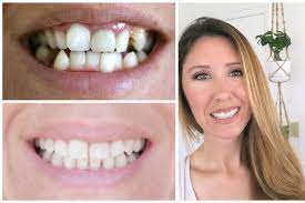 Dr. Jyotika Kaushik Goodman is Top 1% Invisalign provider in the country!