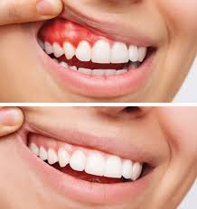 This patient always felt like it looked like food was stuck in her teeth - laser depigmentation was performed in one painless visit to change the way she felt about her smile