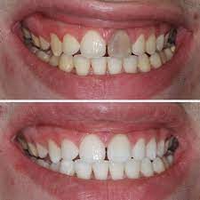 After 10+ years of being told nothing could be done, the patient couldn't believe the stunning results after this one-visit procedure