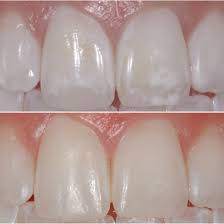 Drill-free, needle-free, pain-free ICON treatment to rid of white spots