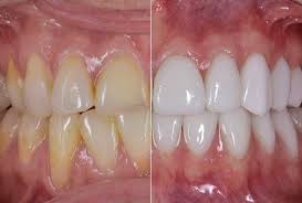 Congenitally discolored enamel and cavities were treated with handcrafted porcelain veneers for this gorgeous patient.