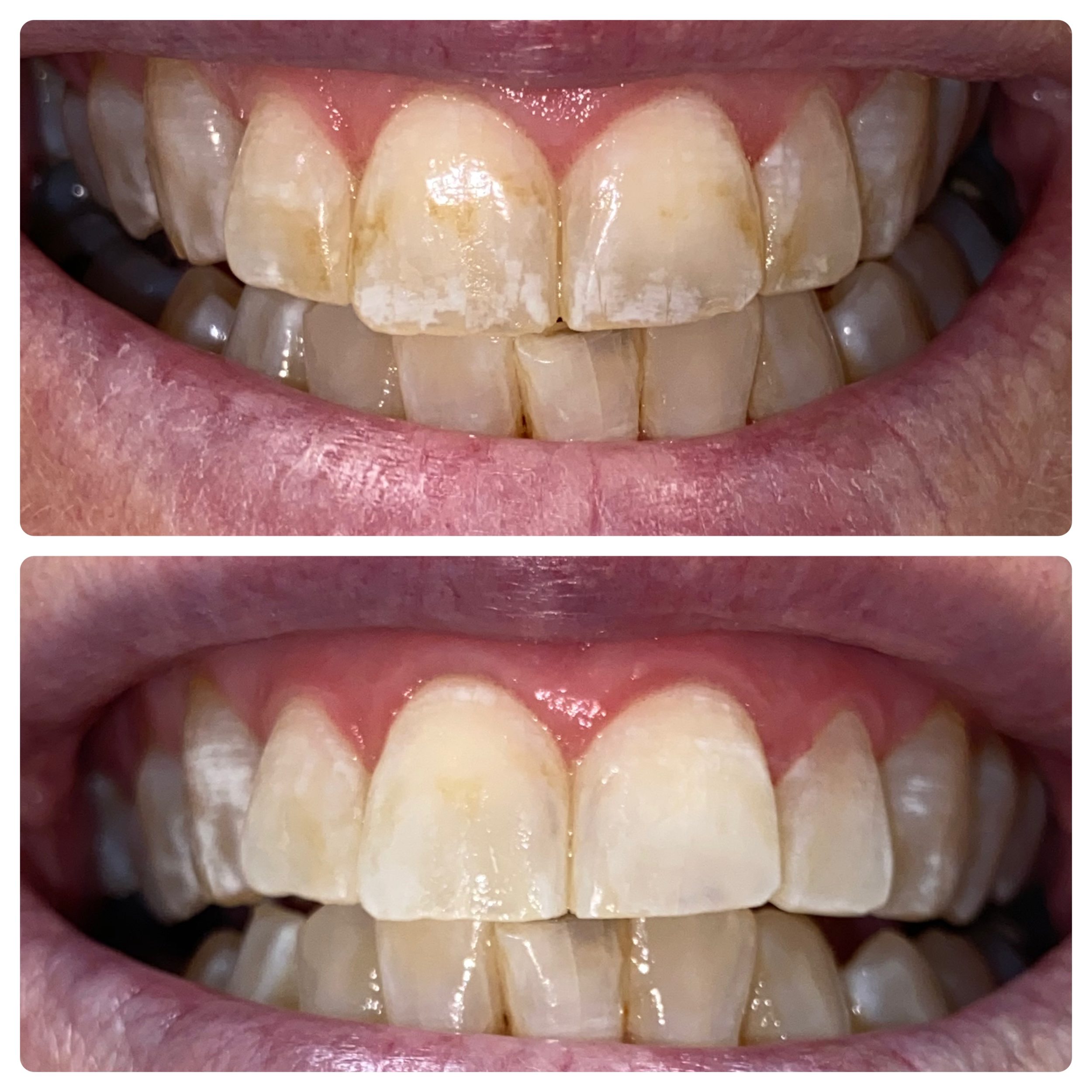 Drill-free, needle-free, pain-free ICON treatment to rid of white spots