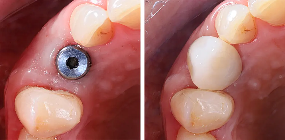 Seamless transition from no tooth to a naturally looking implant crown