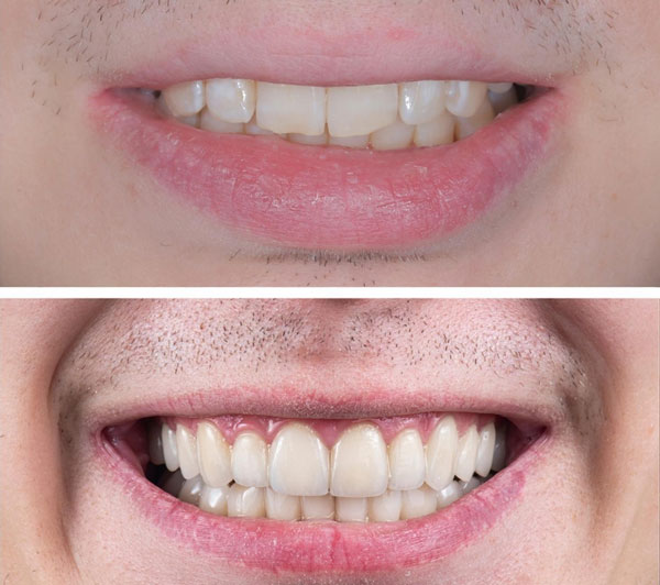 Dr. Jyotika Kaushik Goodman is Top 1% Invisalign provider in the country!
