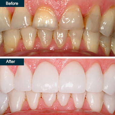 Congenitally discolored enamel and cavities were treated with handcrafted porcelain veneers for this gorgeous patient.