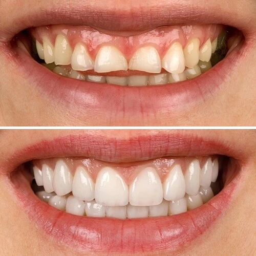 Cavities on two front teeth - fillings were placed to make it look like nothing ever happened