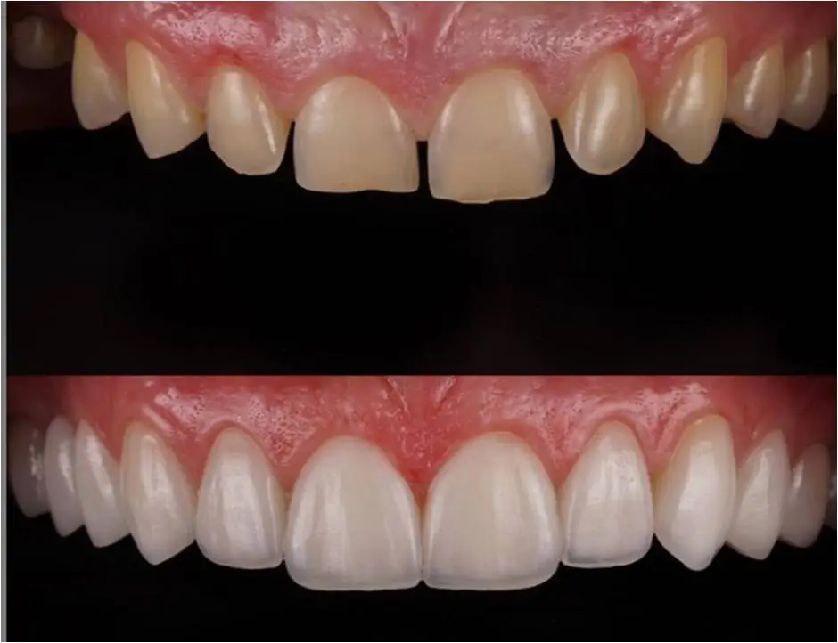 Congenitally discolored enamel and cavities were treated with handcrafted porcelain veneers for this gorgeous patient.